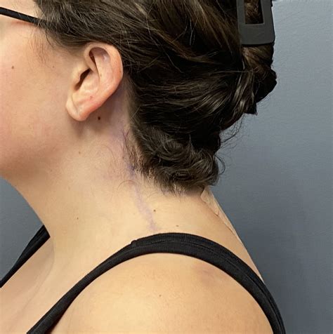 Plastic Surgery Case Study - Webbed Neck Correction with Buffalo Hump ...