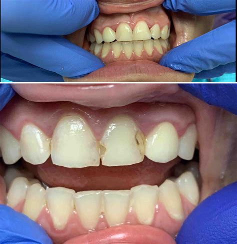 Front Tooth Cavity Filling