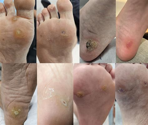 Plantar Wart Removal Stages Removal Progress Pics With SA (Plantar