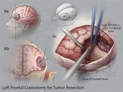 Left Frontal Craniotomy for Tumor Resection - Alisa Brandt's Portfolio