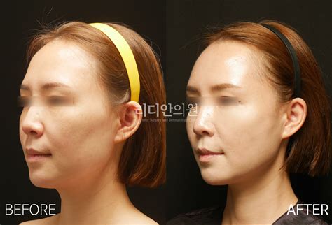 Face Fat Grafting Procedure at Ty Pace blog