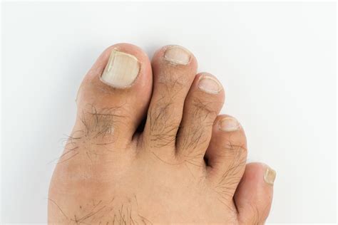 Toenail White And Chalky