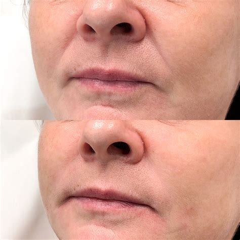 Nasolabial Folds Treatment - Rejuvenate Clinics