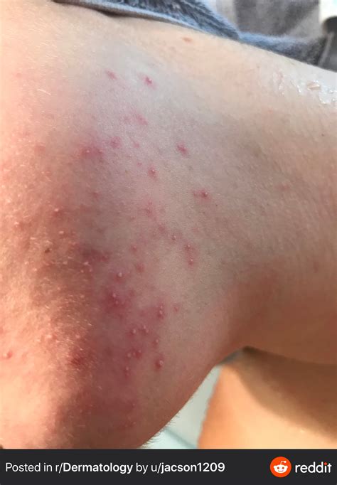 Gram Negative Folliculitis? – Acne – Acne.org Forum
