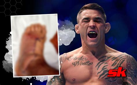 Dustin Poirier shares graphic update on staph infection as his foot ...