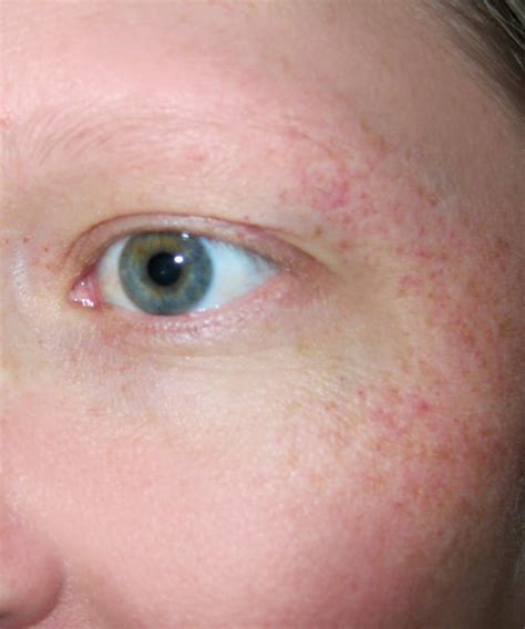 Throwing Up Causing Broken Blood Vessels at Lauren Blackwell blog