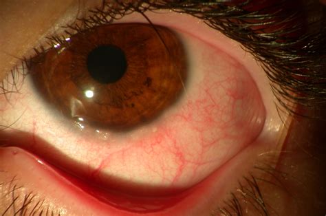 Vernal keratoconjunctivitis (VKC) | www.ocular-surface.org