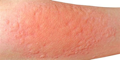Contact Dermatitis Treatments | SLO | Coastal Dermatology