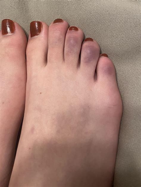 206 best r/raynauds images on Pholder | My toes have been getting ...