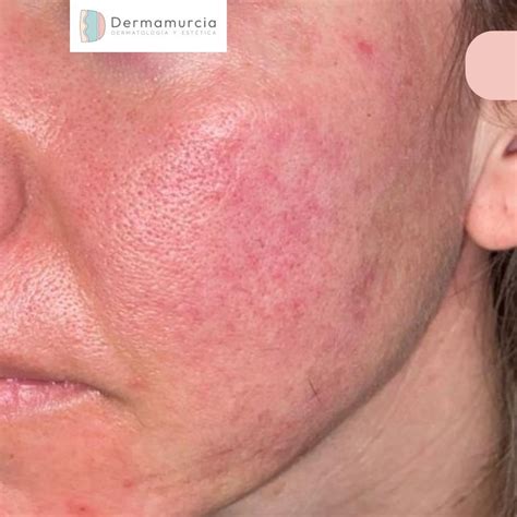 Dermatitis Por Rhus En La Cara Todo Acerca De La Dermatitis Atópica