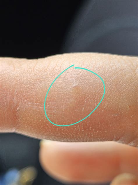 Very small blister-like bumps : r/skin