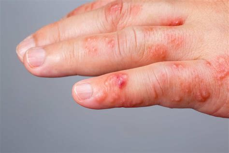 Scabies Specialist Advice - London | Harley Street Dermatology Clinic