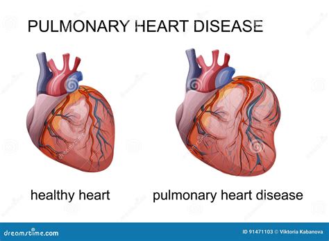 Heart Disease Set. Atherosclerosis, Thrombus, Coronary Artery Spasm ...