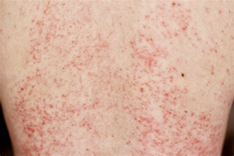 Stevens Johnson Syndrome Mild Rash