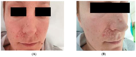 Brooke Spiegler Syndrome