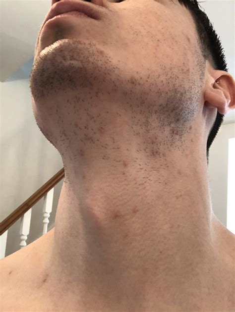 Red Marks On Neck During Pregnancy at Shawn Rooks blog