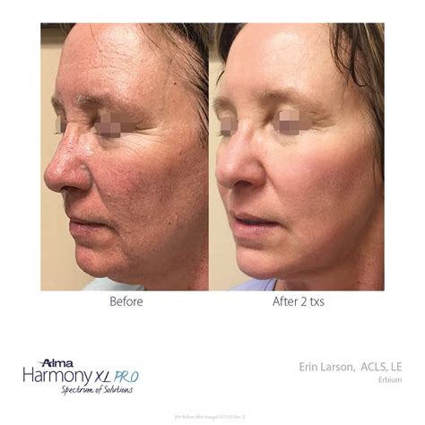 Pixel Erbium laser Skin Resurfacing - MIYA Aesthetics & Wellness