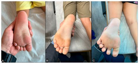 The Autistic Toe Walking: A Narrative Review for Interventions and Comparison with Idiopathic ...