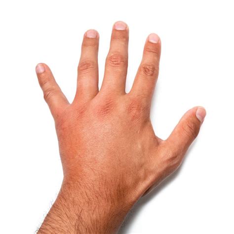 Signs That You May Have a Fracture in Your Hand - The Vu Center