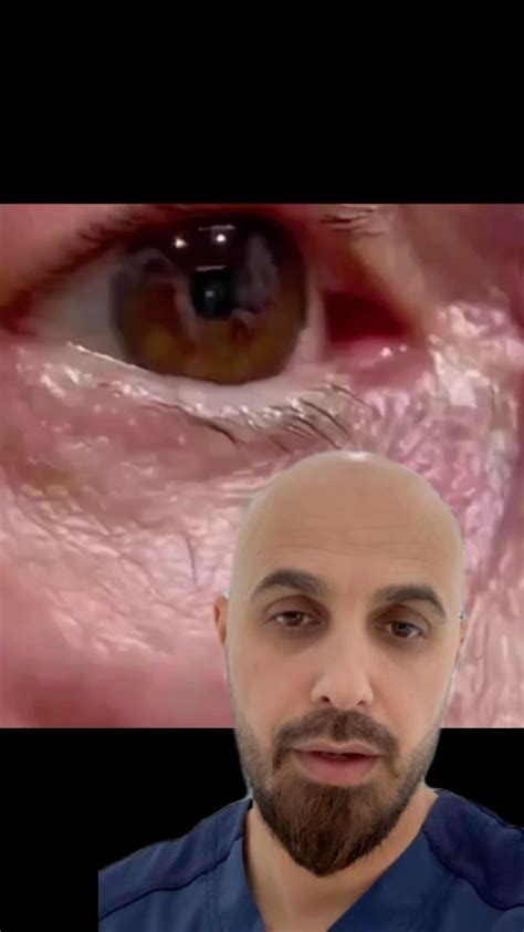 Mohammad Abu Ali | Physical therapist | Myokymia refers to the involuntary, fine, and continuous ...