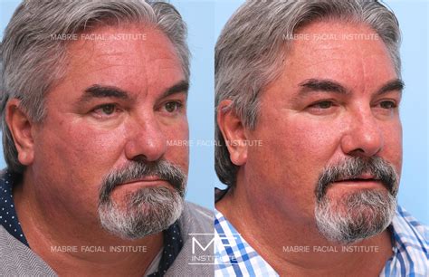 Forehead Wrinkles & Frown Lines Before and After Pictures Case 655 | San Francisco, CA | Mabrie ...