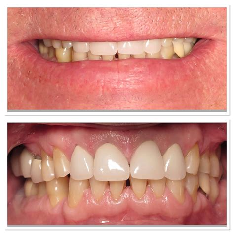 K Michelle Before And After Teeth