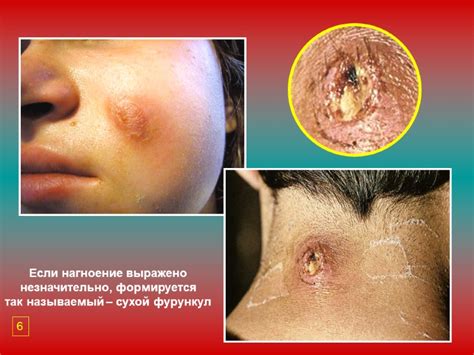 Фурункулы и карбункулы лица и шеи. Этиология, клиника,