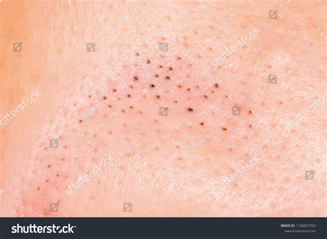 Blackheads On Forehead