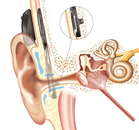 Cochlear Americas Cochlear Implants Bone Anchored Hearing Aids - Form example download