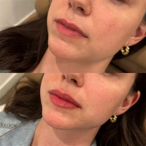 Lip Filler Before and After - Before After Journey