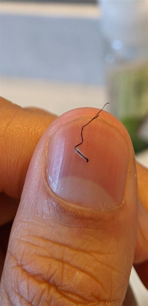 An infected beard follicle that I pulled out, this was hurting real bad | Scrolller