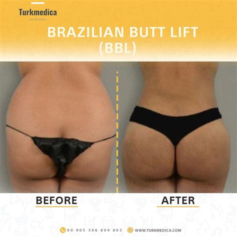 Butt Lift Surgery
