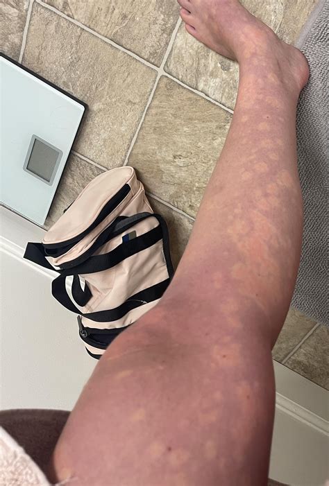 Chronic Urticaria for 3.5 months, what a maddening roller coaster. Get me off this ride! : r ...
