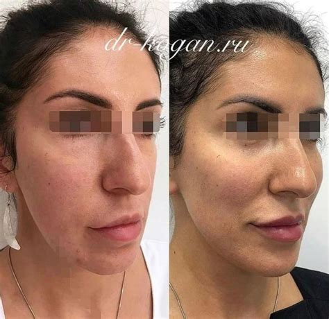 Ботокс Full Face - мгновенное преображение - Cosmetic-clinic