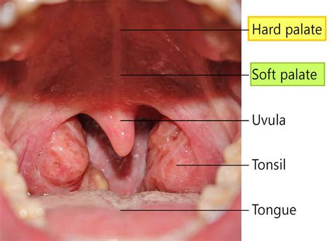 Cause Of Sore On Hard Palate at Ruby Najar blog