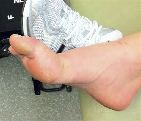 Turf toe injury | Emergency Medicine Journal