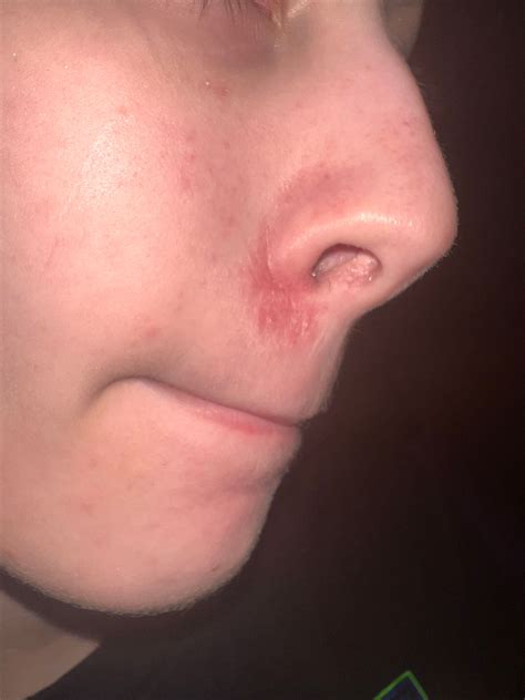 Dry Skin Around Nose