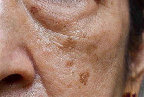What’s the difference between freckles, sunspots and moles?