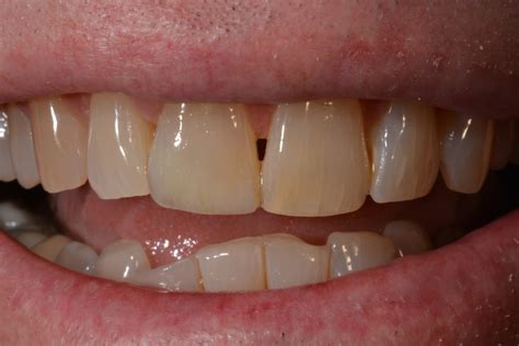 Dental Bonding On Front Teeth at Timothy Samons blog