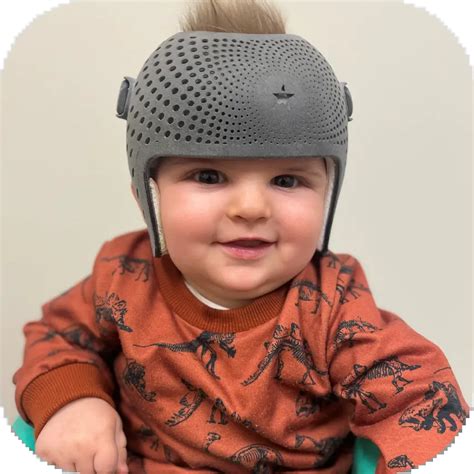 Head Shaping Helmet | Head Shape Clinic Calgary