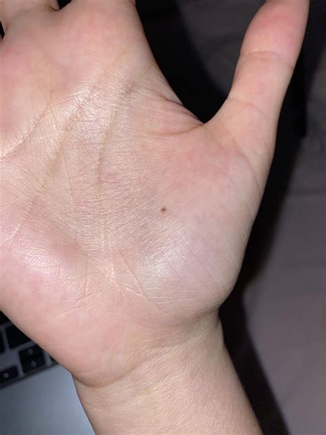 This mole on my palm keeps growing, what is it? It’s been bothering me ...