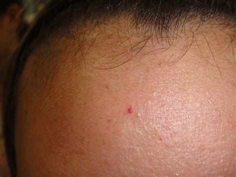 Cherry Angioma