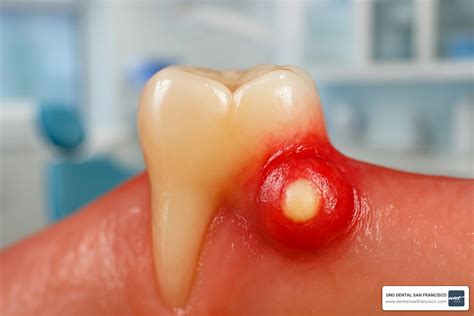 Abscess Tooth Removal