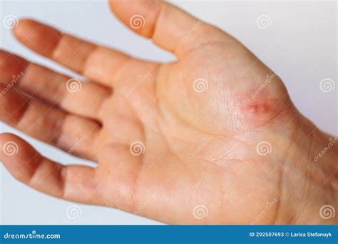 Herpes on Palm Woman& X27;s Hand Stock Image - Image of enterovirus, blisters: 292507693
