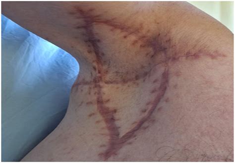 Surgical Treatment of Axillary Hidradenitis Suppurativa Using Preliminary Defect Closure and Two ...
