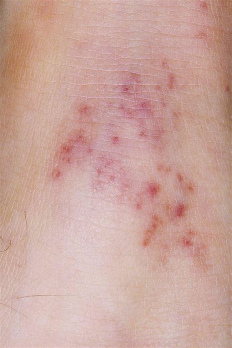 Bleeding Into the Skin: Appearance, Causes, Healing