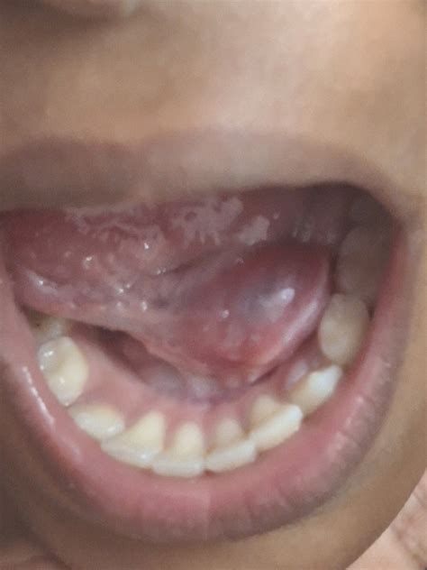 Swelling under tongue : r/OralSurgery