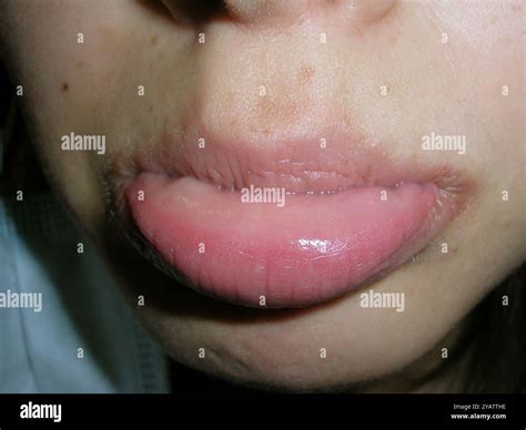 Lip of a female patient after the removal of a mucocele with cryo tweezers. A mucocele, or mucus ...
