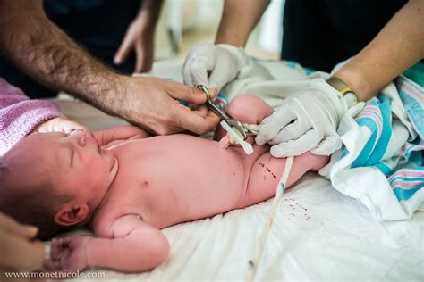 What Is Umbilical Cord Clamping at Kristen Mcdonald blog