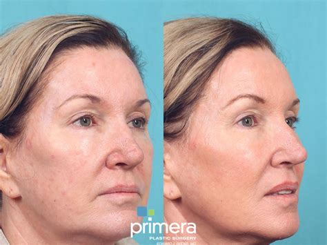 Laser Skin Resurfacing (DOT CO2) Before and After Pictures Case 947 | Orlando, Winter Park ...